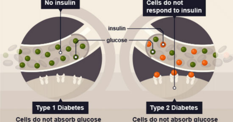 Stem Cell Therapy for Type 1 Diabetes: A Comprehensive Overview